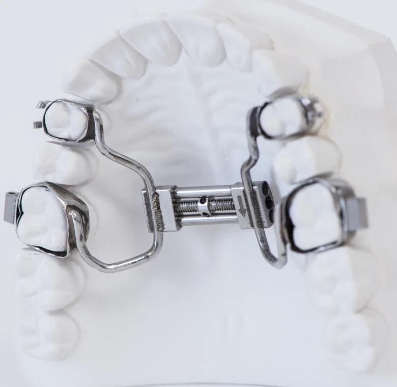 Traitement interceptif au cabinet d'orthodontie du Dr Sayagh à Menton